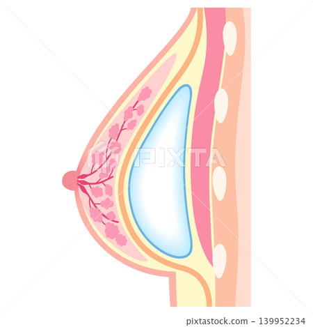 矽膠假體隆乳：隆乳手術結構，胸大肌下筋膜法。 139952234