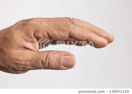 Skin peeling due to an allergic reaction. Skin peeling due to an allergic reaction. 139952339