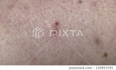 Close up macro of caucasian human skin with two small red healing scabs or insect bites, concept of minor dermatological problem and healthcare Close up macro of caucasian human skin with two small red healing scabs or insect bites, concept of minor dermatological problem and healthcare 139955595