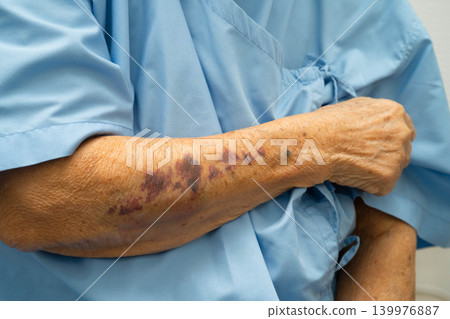 Ecchymosis, elderly bleeding on her arm after taking aspirin. 139976887