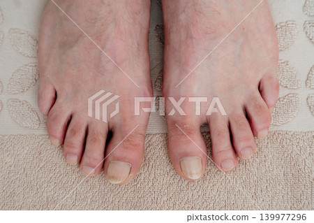 Close-up of a men's feet without manicure and toe fungus. High quality photo 139977296
