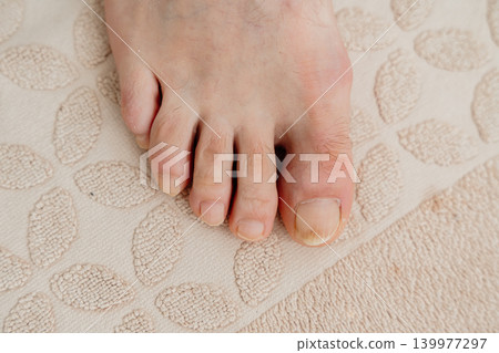 Close-up of a man's foot without manicure and toe fungus. High quality photo 139977297