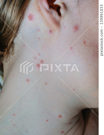 Close-up of a woman with chicken pox Close-up of a woman with chicken pox 139991833