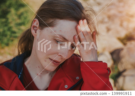 Portrait of a sad woman with chicken pox outdoors Portrait of a sad woman with chicken pox outdoors 139991911