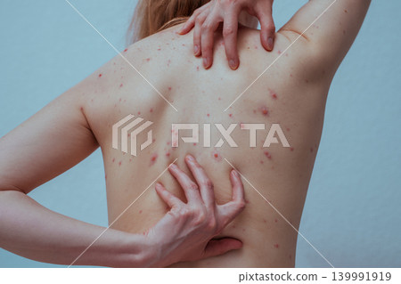 A woman with chicken pox scratches her back A woman with chicken pox scratches her back 139991919