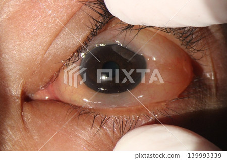 Chemosis. Slit-lamp close-up image demonstrating diffuse bullous edema of the bulbar conjunctiva consistent with allergic conjunctivitis Chemosis. Slit-lamp close-up image demonstrating diffuse bullous edema of the bulbar conjunctiva consistent with allergic conjunctivitis 139993339