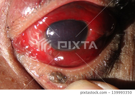 Severe hemorrhagic chemosis with corneal edema and hyphema Severe hemorrhagic chemosis with corneal edema and hyphema 139993350