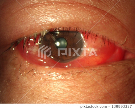Slit-lamp photograph showing conjunctival edema (chemosis) associated with allergic conjunctivitis Slit-lamp photograph showing conjunctival edema (chemosis) associated with allergic conjunctivitis 139993357