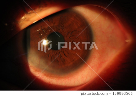 Conjunctivitis. Slit-lamp photo of a marked conjunctival hyperemia and vascular congestion secondary to infection, accompanied by superficial corneal neovascularization 139993565