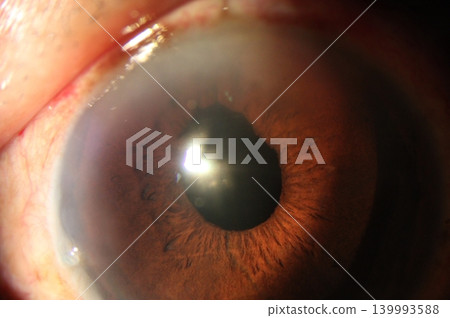 Close-up of an eye with displaced pupil 139993588