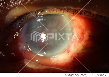 Corneal edema. Close-up slit lamp photo of postoperative corneal edema presenting as diffuse corneal haze after cataract surgery 139993647