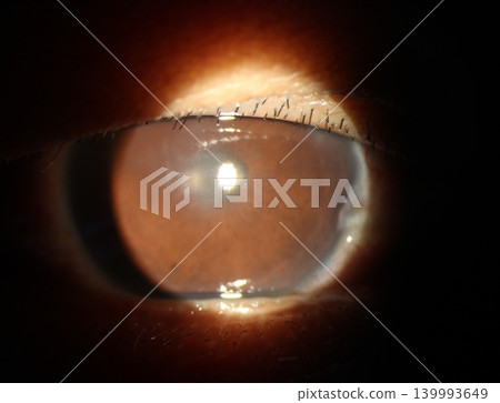 Slit lamp photograph depicting postoperative central corneal edema in a patient after cataract surgery 139993649