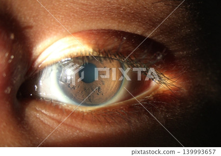 Detailed slit lamp view highlighting iris crypts on the anterior iris 139993657