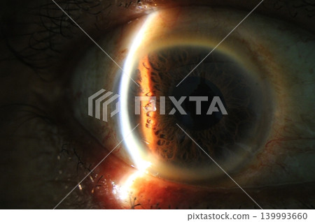 Multiple iris crypts in the anterior segment observed under slit beam illumination 139993660