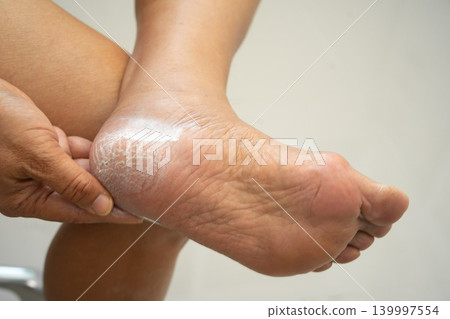 Asian woman care feet with cracked and dry heel skin cream at home. 139997554