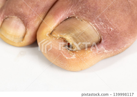Ingrown toenail on a senior feet with white backgroundClose-up ingrown toenail on senior feet with white background. 139998117