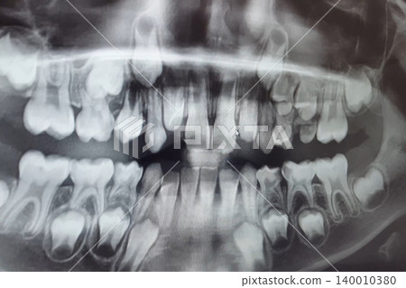 X-RAY PICTURE OF DAIRY AND NEW CHILDRENS TEETH. X-RAY PICTURE OF DAIRY AND NEW CHILDRENS TEETH. 140010380