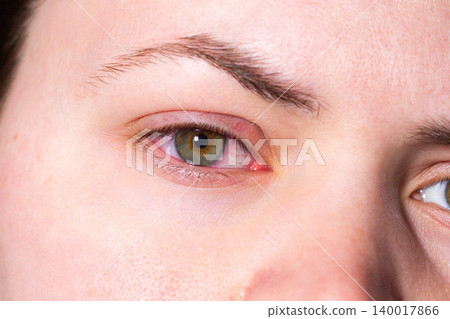 Close up of a young woman red, irritated eye from conjunctivitis. Medical exam needed. Ophthalmologist consultation, eye drops prescription. Vision check urgency for clinic advertising Close up of a young woman red, irritated eye from conjunctivitis. Medical exam needed. Ophthalmologist consultation, eye drops prescription. Vision check urgency for clinic advertising 140017866