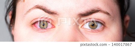 Close up of a young woman red, irritated eye from conjunctivitis. Medical exam needed. Ophthalmologist consultation, eye drops prescription. Vision check urgency for clinic advertising Close up of a young woman red, irritated eye from conjunctivitis. Medical exam needed. Ophthalmologist consultation, eye drops prescription. Vision check urgency for clinic advertising 140017867
