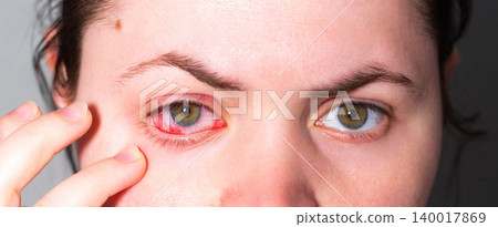 Red eye due to viral or bacterial infection. Eye doctor examining inflamed conjunctiva. Medical clinic photography for health articles 140017869