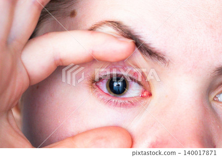 Woman showing red eye and enlarged pupil after ophthalmologist visit. Medical prescription for conjunctivitis treatment. Medical eye test in clinic Woman showing red eye and enlarged pupil after ophthalmologist visit. Medical prescription for conjunctivitis treatment. Medical eye test in clinic 140017871