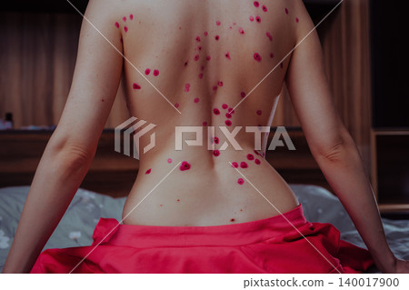 Woman with chicken pox on her back in the bedroom Woman with chicken pox on her back in the bedroom 140017900