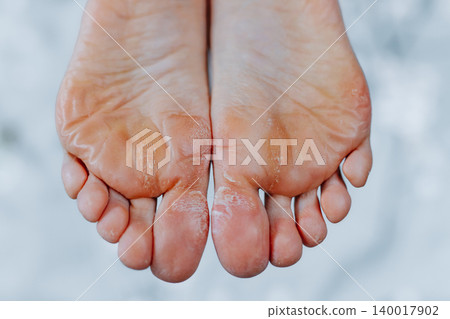 Unkempt woman feet, woman feet without pedicure Unkempt woman feet, woman feet without pedicure 140017902