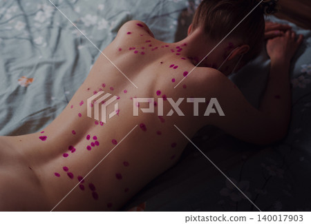 Woman with chicken pox lying on bed Woman with chicken pox lying on bed 140017903