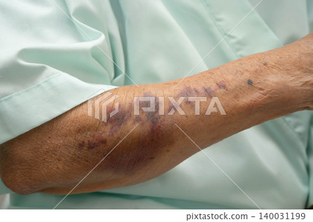 Ecchymosis, elderly bleeding on her arm after taking aspirin. 140031199