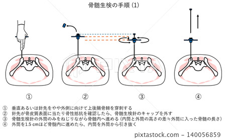 骨髓切片檢查程序（1） 140056859
