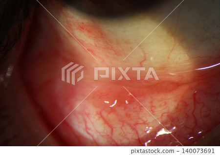 Close-up of small, multiple conjunctival cysts during ophthalmic examination Close-up of small, multiple conjunctival cysts during ophthalmic examination 140073691