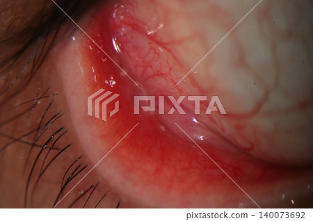 Close-up slit lamp image showing a translucent conjunctival retention cyst located on the lower tarsal conjunctiva with surrounding mild hyperemia Close-up slit lamp image showing a translucent conjunctival retention cyst located on the lower tarsal conjunctiva with surrounding mild hyperemia 140073692
