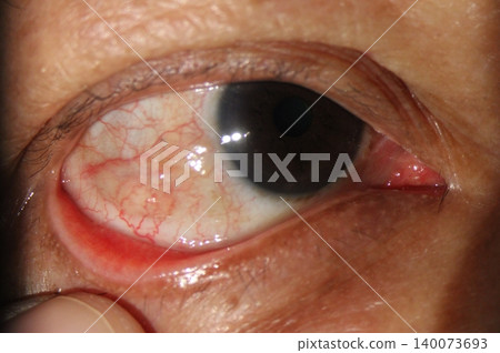 Conjunctival inclusion cyst on the temporal bulbar conjunctiva Conjunctival inclusion cyst on the temporal bulbar conjunctiva 140073693