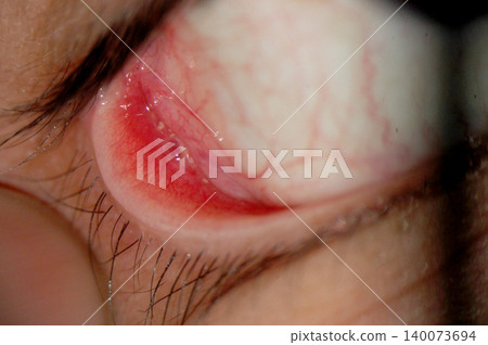 Conjunctival inclusion cyst with surrounding lithiasis and conjunctival hyperemia Conjunctival inclusion cyst with surrounding lithiasis and conjunctival hyperemia 140073694