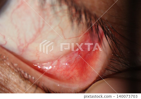 Multiple small conjunctival cysts associated with conjunctival hyperemia Multiple small conjunctival cysts associated with conjunctival hyperemia 140073703