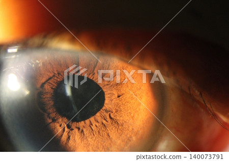 Close-up image showing a displaced intraocular lens haptic consistent with intraocular lens dislocation Close-up image showing a displaced intraocular lens haptic consistent with intraocular lens dislocation 140073791