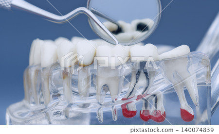 Oral health and pathology concept. Dental mirror reflecting deep tooth decay on a clear anatomical jaw model with visible roots and cysts. Oral health and pathology concept. Dental mirror reflecting deep tooth decay on a clear anatomical jaw model with visible roots and cysts. 140074839