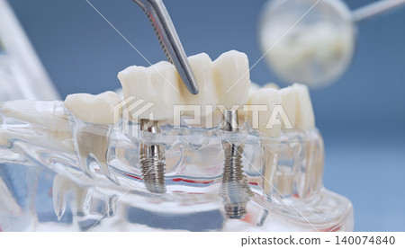 Dental implantology and prosthetics concept. Tweezers placing a ceramic bridge on titanium implants in a transparent jaw model. Dental implantology and prosthetics concept. Tweezers placing a ceramic bridge on titanium implants in a transparent jaw model. 140074840
