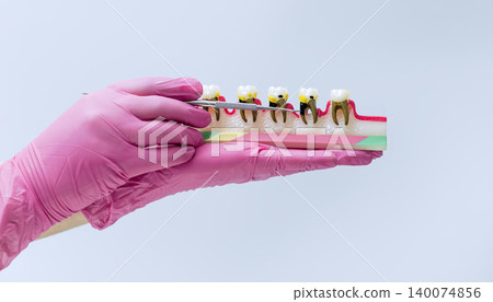 Dentist hands holding an anatomical model pointing at severe tooth decay. Deep caries and endodontics concept. Dentist hands holding an anatomical model pointing at severe tooth decay. Deep caries and endodontics concept. 140074856