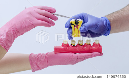 Dentist pointing at deep tooth decay on a cross-section anatomy model. Pulpitis, endodontics, and patient education concept. Dentist pointing at deep tooth decay on a cross-section anatomy model. Pulpitis, endodontics, and patient education concept. 140074860