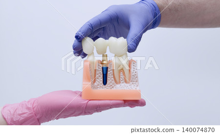 Dentist hands in blue and pink gloves placing a dental bridge onto an anatomical implant model. Cross-section jawbone. Dentist hands in blue and pink gloves placing a dental bridge onto an anatomical implant model. Cross-section jawbone. 140074870