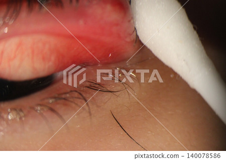 Clinical view of eyelid eversion revealing conjunctival hyperemia and one detached lower eyelash Clinical view of eyelid eversion revealing conjunctival hyperemia and one detached lower eyelash 140078586