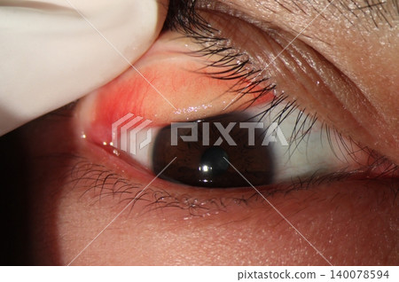 Slit lamp image showing eyelid eversion with conjunctival hyperemia and papillae 140078594
