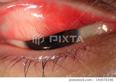 Slit lamp photograph of an everted upper eyelid showing conjunctival hyperemia and papillary reaction Slit lamp photograph of an everted upper eyelid showing conjunctival hyperemia and papillary reaction 140078596