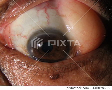 Clinical image showing a soft, smooth, yellow-orange subconjunctival mass in the corner of the eye indicative of orbital fat prolapse 140078608