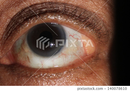 Distinct, pliable yellowish subconjunctival mass in the corner of the eye, indicative of orbital fat prolapse 140078610