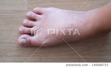 Close up on torn fingernail on the thumb. Shot of a human bare foot resting horizontally on a light brown wooden or laminate floor surface. Skin texture toes and individual nails clearly. Close up on torn fingernail on the thumb. Shot of a human bare foot resting horizontally on a light brown wooden or laminate floor surface. Skin texture toes and individual nails clearly. 140086725