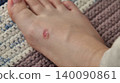 Close-up of a Blister on a Human Foot 140090861