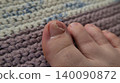 Close-up of a discolored and possibly fungal toenail 140090872