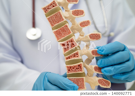 Doctor holding osteoporosis in back bone model. Doctor holding osteoporosis in back bone model. 140092771